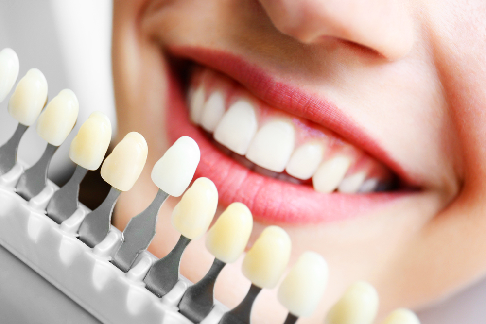Young woman choosing color of teeth at dentist, closeup